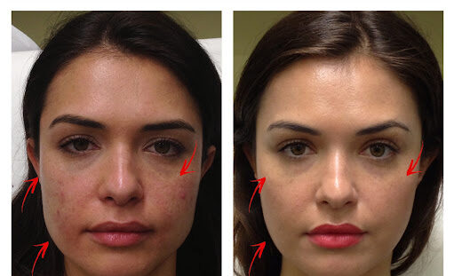 Dermal fillers