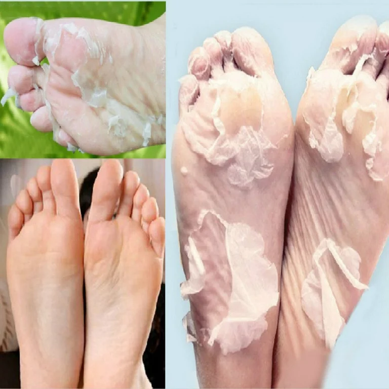 Hand & Feet Peel Treatment