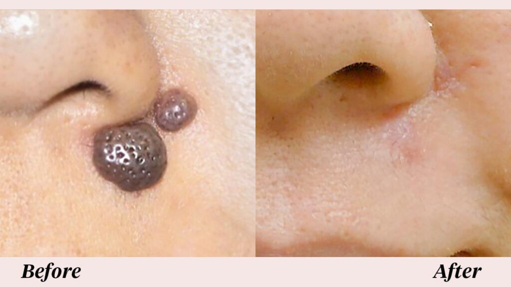 Mole Removal