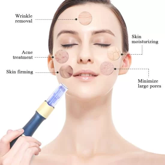 micro needling